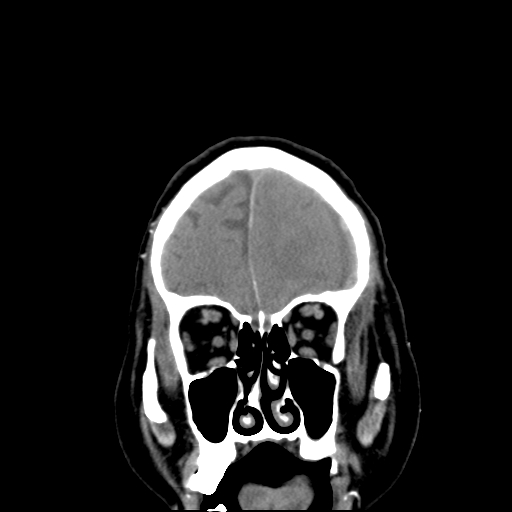 Acute hemorrhagic stroke (Radiopaedia 17507-17223 Coronal non-contrast 9).jpg