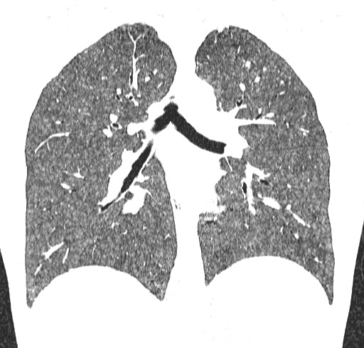 Acute hypersensitivity pneumonitis (Radiopaedia 85293-100870 Coronal lung window 77).jpg