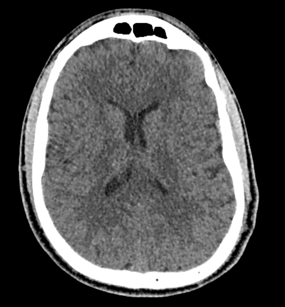 Acute ischemic stroke - posterior circulation territory (Radiopaedia 77670-89881 non-contrast 53).jpg