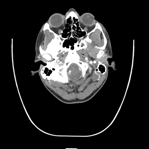 Acute longus colli calcific tendinitis (Radiopaedia 72495-83036 Axial C+ arterial phase 9).jpg