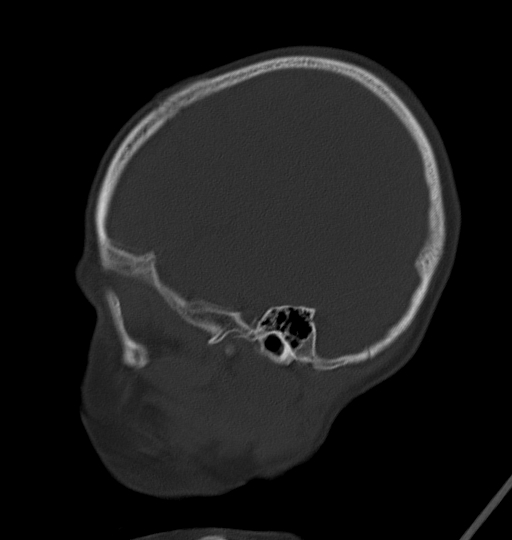 Acute mastoiditis (Radiopaedia 82678-96881 Sagittal bone window 11).jpg