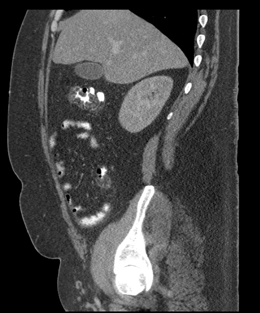 Acute mesenteric venous ischemia (Radiopaedia 46041-50383 Sagittal C+ portal venous phase 31).jpg