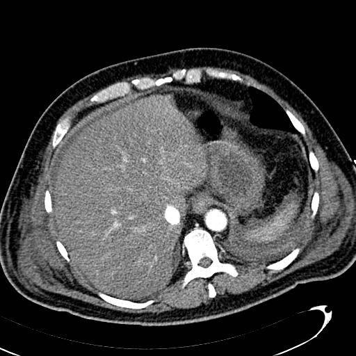 File:Acute pancreatic necrosis (Radiopaedia 13560-13486 Axial C+ portal venous phase 29).jpg