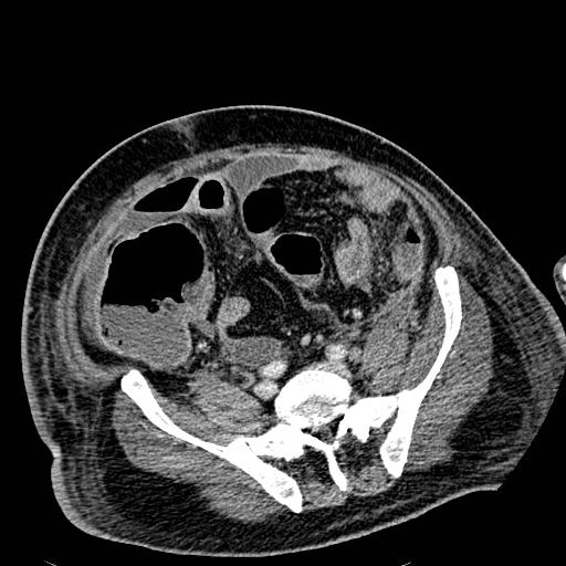 File:Acute pancreatic necrosis (Radiopaedia 13560-18501 Axial C+ portal venous phase 105).jpg