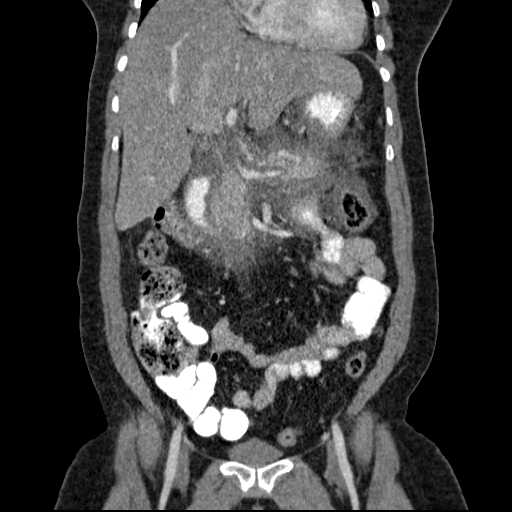 File:Acute pancreatitis (Radiopaedia 20829-20744 Coronal C+ portal venous phase 23).jpg