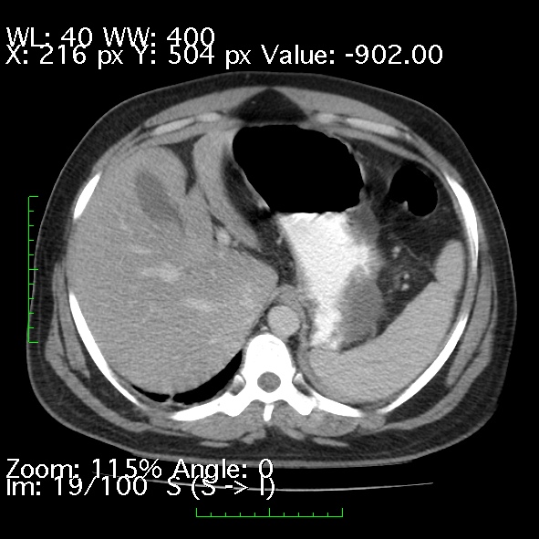 Acute pancreatitis (Radiopaedia 34043-35276 Axial C+ portal venous phase 19).jpg