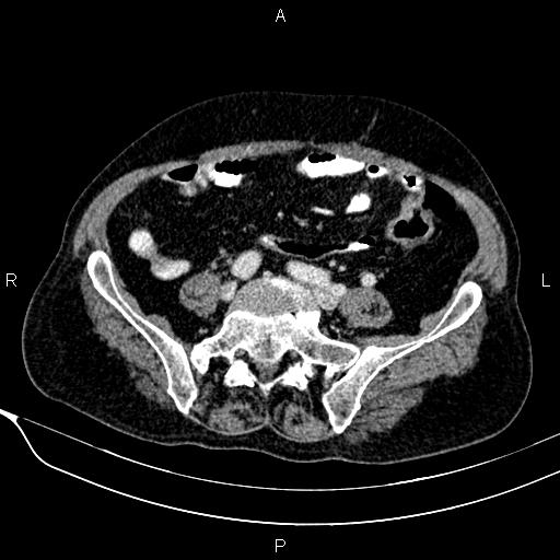 Acute pancreatitis (Radiopaedia 85146-100701 Axial C+ portal venous phase 47).jpg