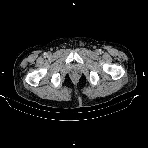 Acute pancreatitis (Radiopaedia 85390-101010 Axial C+ portal venous phase 113).jpg