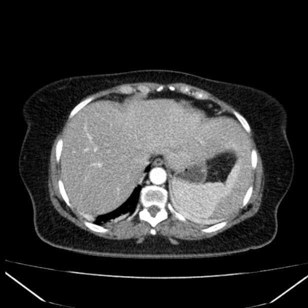 Acute pancreatitis - Balthazar C (Radiopaedia 26569-26714 Axial C+ arterial phase 13).jpg