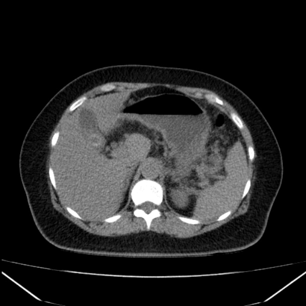 Acute pancreatitis - Balthazar C (Radiopaedia 26569-26714 Axial non-contrast 28).jpg