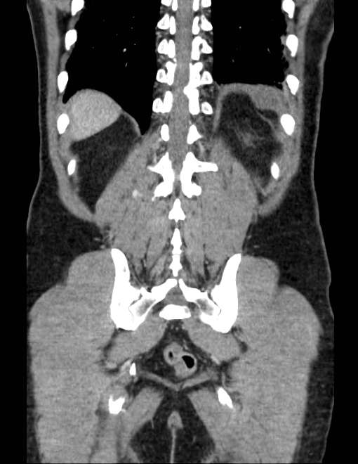 Acute pancreatitis - Balthazar E (Radiopaedia 23080-23110 Coronal C+ portal venous phase 66).jpg