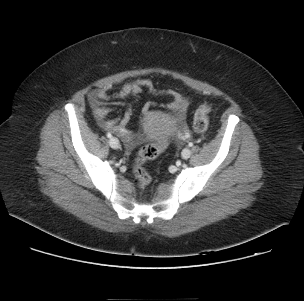 File:Acute pancreatitis - Balthazar E (Radiopaedia 29016-29377 Axial C+ portal venous phase 60).png