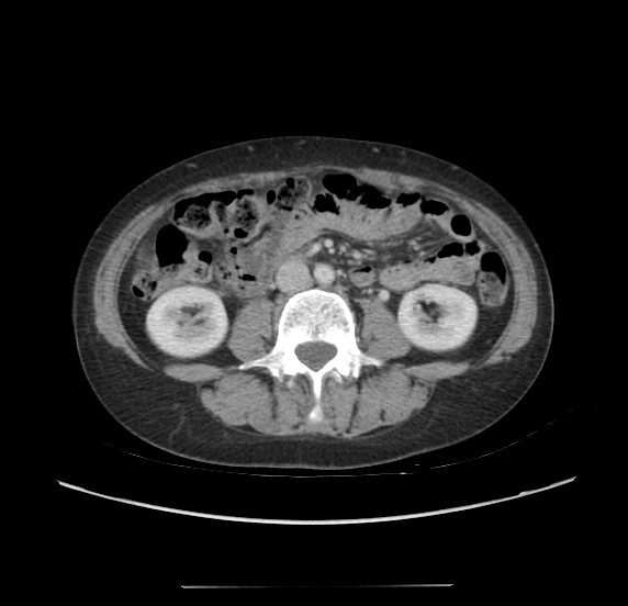 File:Acute pancreatitis - Balthazar E - post ERCP (Radiopaedia 27562-27772 Axial C+ portal venous phase 41).png