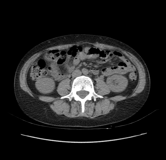 File:Acute pancreatitis - Balthazar E - post ERCP (Radiopaedia 27562-27772 Axial non-contrast 35).png