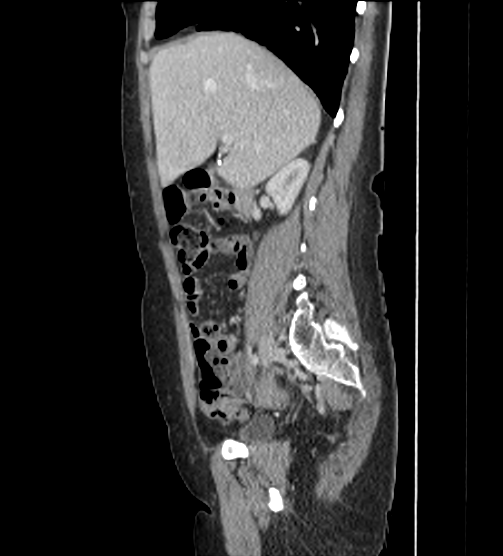 File:Acute pancreatitis - Balthazar E - post ERCP (Radiopaedia 27562-27772 Sagittal C+ portal venous phase 43).png