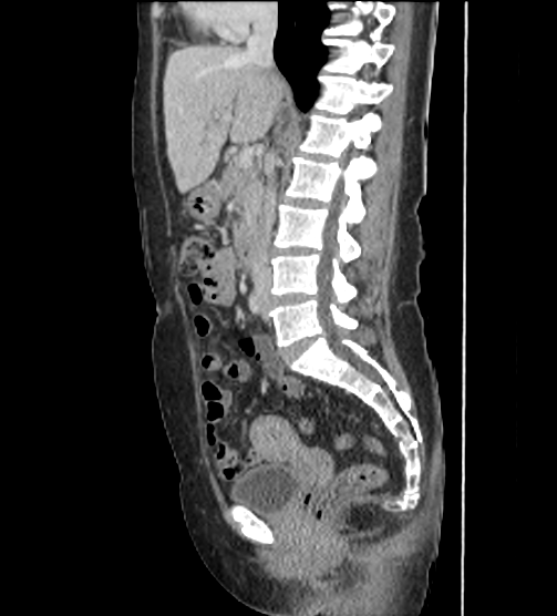 File:Acute pancreatitis - Balthazar E - post ERCP (Radiopaedia 27562-27772 Sagittal C+ portal venous phase 62).png