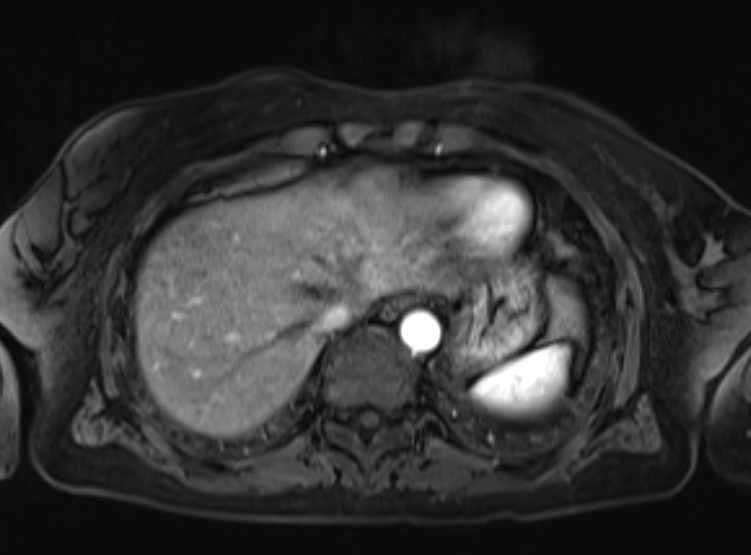 Acute pancreatitis - Balthazar E - post ERCP (Radiopaedia 27562-27778 Axial VIBE C+ 17).png