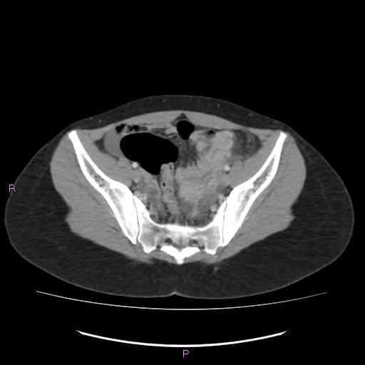 Acute pancreatitis secondary to stone at minor papilla and pancreatic divisum (Radiopaedia 76570-88333 Axial C+ portal venous phase 64).jpg
