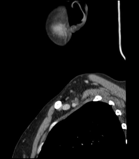 File:Acute parotitis (Radiopaedia 27425-27619 Sagittal C+ portal venous phase 4).png