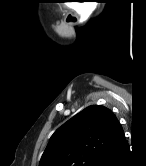 Acute parotitis (Radiopaedia 27425-27619 Sagittal C+ portal venous phase 52).png