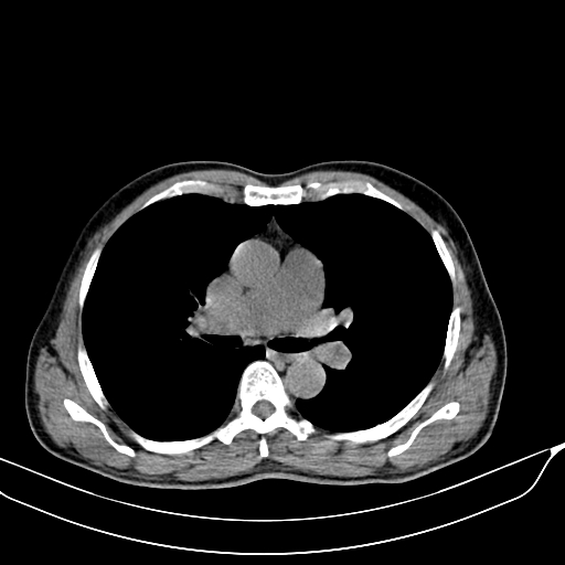 File:Acute pulmonary embolism (Radiopaedia 69510-79390 Axial non-contrast 1).jpg