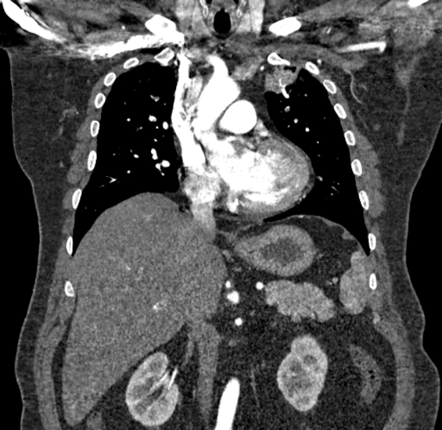 Acute pulmonary embolism with pulmonary infarcts (Radiopaedia 77688-89908 Coronal C+ CTPA 37).jpg