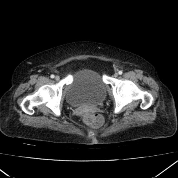 Acute pyelonephritis (Radiopaedia 26584-26729 Axial renal cortical phase 71).jpg