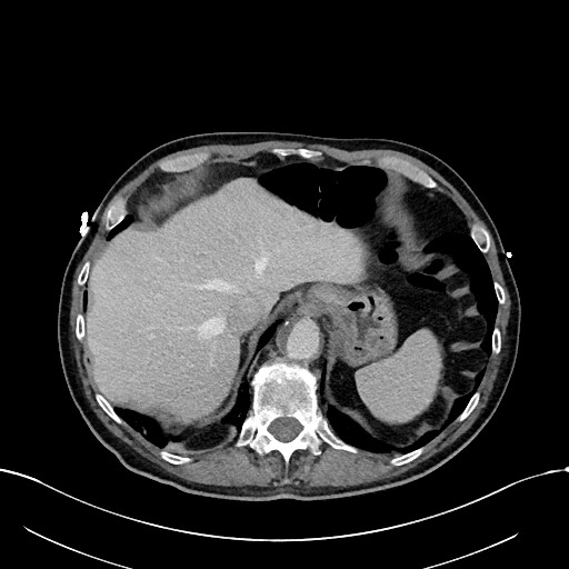 File:Acute renal infarction (Radiopaedia 59375-66736 Axial C+ portal venous phase 14).jpg