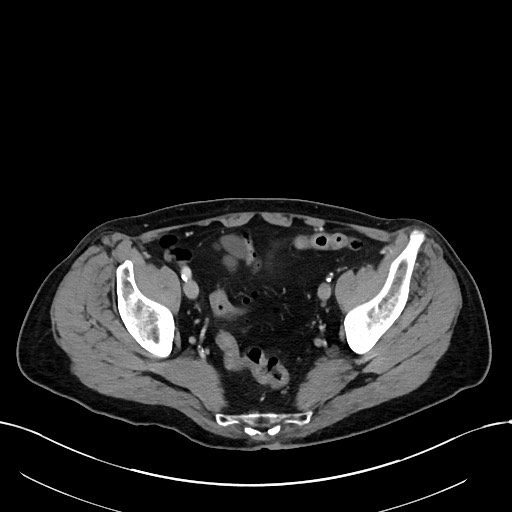 Acute renal infarction (Radiopaedia 59375-66736 Axial C+ portal venous phase 97).jpg