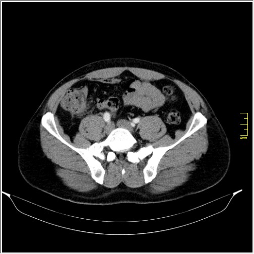 Acute right sided diverticulitis (Radiopaedia 65249-74268 Axial C+ portal venous phase 56).JPG