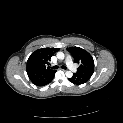 Acute segmental pulmonary emboli and pulmonary infarction (Radiopaedia 62264-70444 Axial C+ CTPA 46).jpg