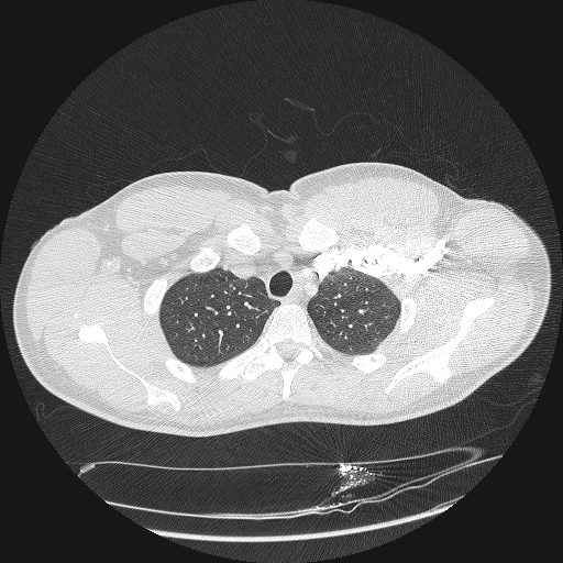 Acute segmental pulmonary emboli and pulmonary infarction (Radiopaedia 62264-70444 Axial lung window 25).jpg