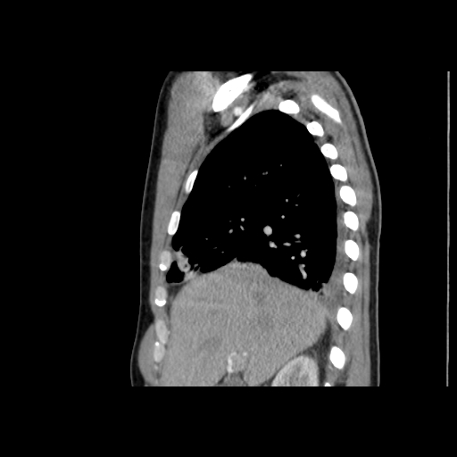 Acute segmental pulmonary emboli and pulmonary infarction (Radiopaedia 62264-70444 Sagittal C+ CTPA 21).jpg