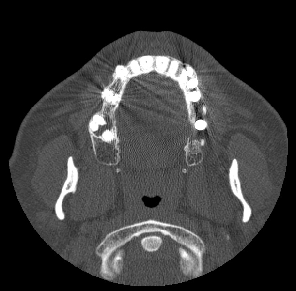 Acute sinusitis (Radiopaedia 23161-23215 Axial bone window 1).jpg