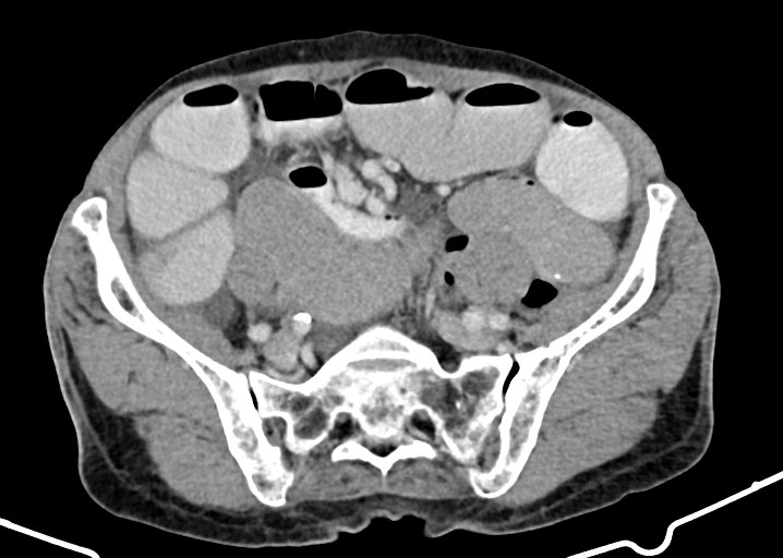 Acute small bowel (ileal) volvulus (Radiopaedia 71740-82139 Axial C+ portal venous phase 147).jpg