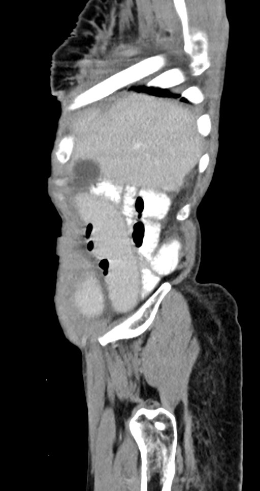 Acute small bowel (ileal) volvulus (Radiopaedia 71740-82139 Sagittal C+ portal venous phase 140).jpg