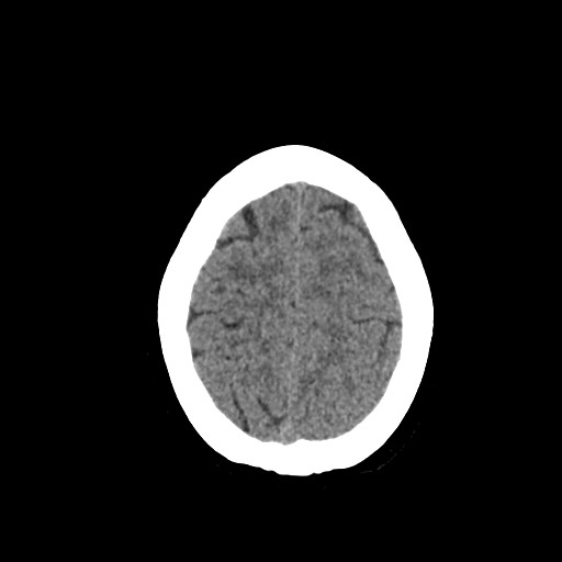 File:Acute subarachnoid hemorrhage and accessory anterior cerebral artery (Radiopaedia 69231-79008 Axial non-contrast 45).jpg