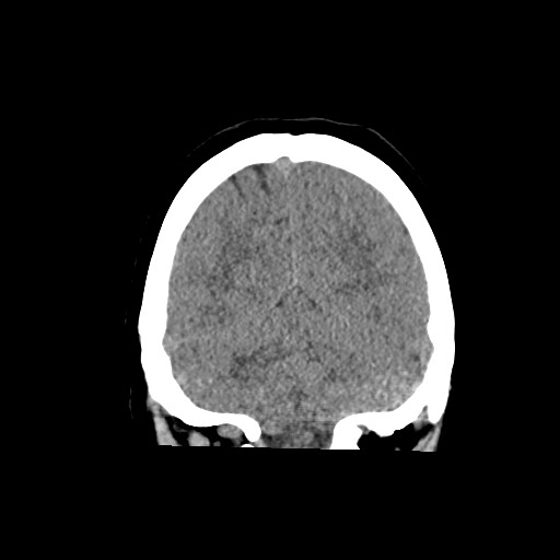 Acute subarachnoid hemorrhage and accessory anterior cerebral artery (Radiopaedia 69231-79008 Coronal non-contrast 55).jpg