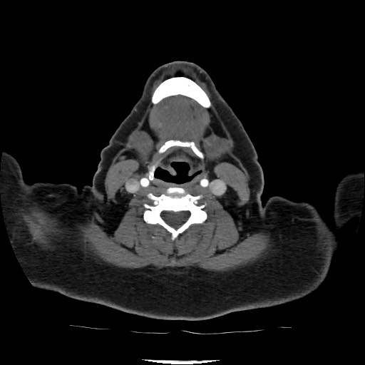 File:Acute subarachnoid hemorrhage and accessory anterior cerebral artery (Radiopaedia 69231-79009 Axial C+ arterial phase 47).jpg