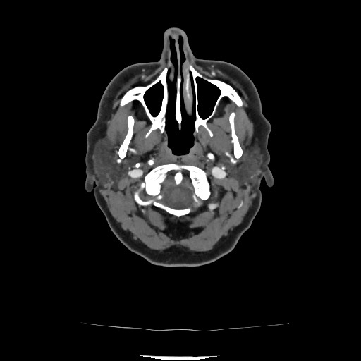 Acute subarachnoid hemorrhage and accessory anterior cerebral artery (Radiopaedia 69231-79009 Axial C+ arterial phase 72).jpg