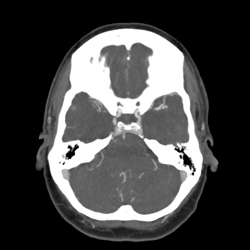 Acute subarachnoid hemorrhage and accessory anterior cerebral artery (Radiopaedia 69231-79009 D 21).jpg