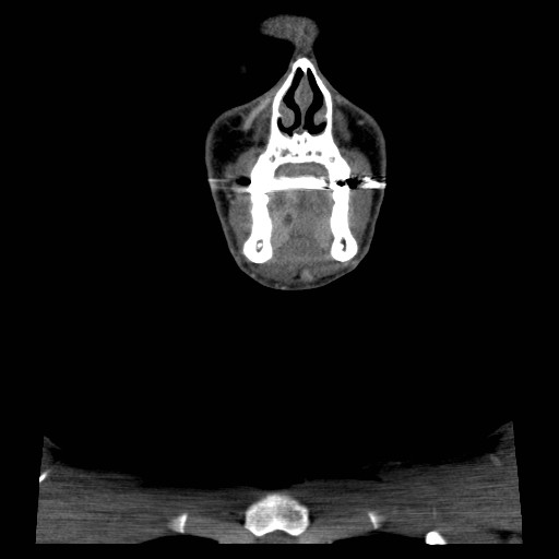 File:Acute submandibular sialadenitis secondary to ductal stone (Radiopaedia 27999-28267 D 10).jpg
