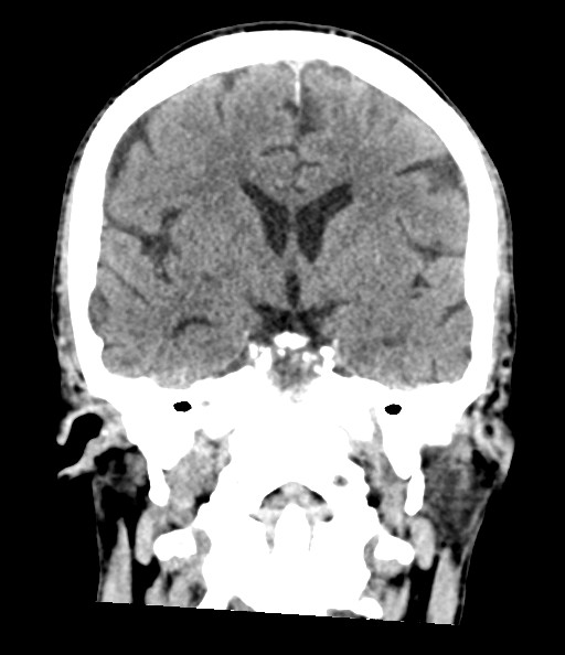 File:Acute superior cerebellar artery territory infarct (Radiopaedia 84104-99359 Coronal non-contrast 48).jpg