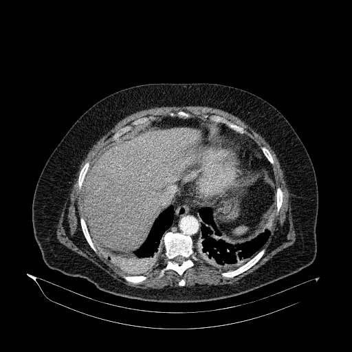 File:Acute superior mesenteric artery occlusion (Radiopaedia 51288-56960 Axial C+ arterial phase 6).jpg