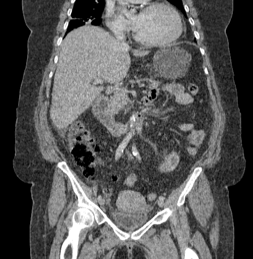 Acute superior mesenteric artery occlusion (Radiopaedia 51288-56960 Coronal C+ portal venous phase 38).jpg