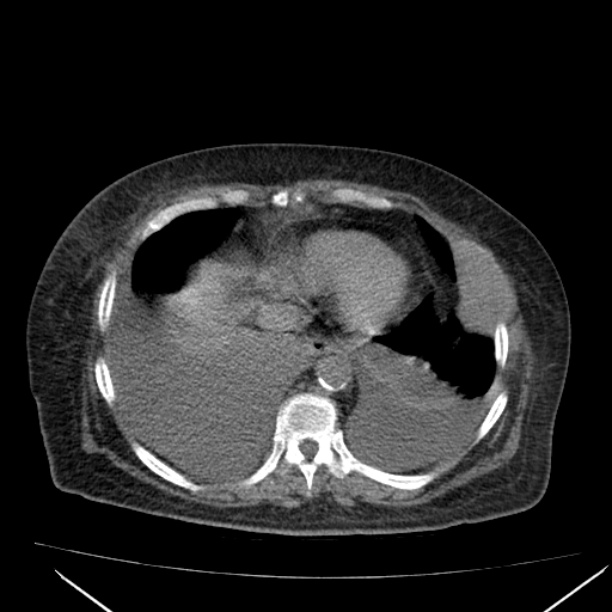 Acute tubular necrosis (Radiopaedia 28077-28334 Axial non-contrast 10).jpg