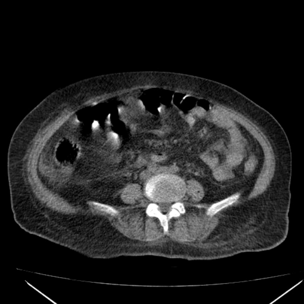 Acute tubular necrosis (Radiopaedia 28077-28334 Axial non-contrast 42).jpg
