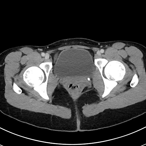 File:Acute uncomplicated appendicitis (Radiopaedia 61374-69304 Axial C+ portal venous phase 125).jpg