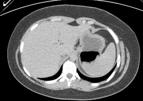 Acute unilateral nonhemorrhagic adrenal infarction (Radiopaedia 67560-76957 Axial renal excretory phase 7).jpg