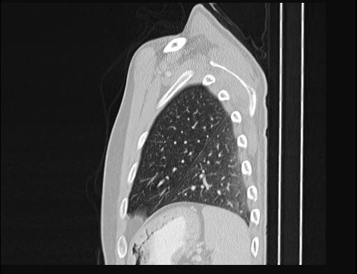 File:Addison disease (Radiopaedia 49318-54412 Sagittal lung window 10).jpg